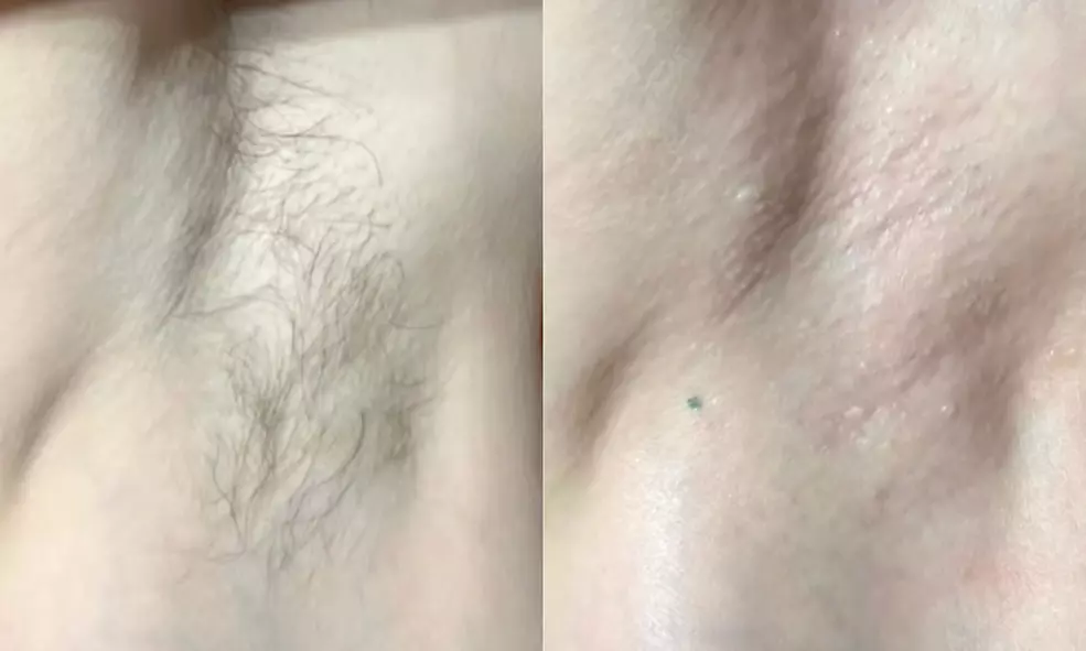 1, 3, or 5 Microdermabrasion Facials w/ LED or High Frequency Therapy