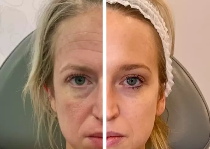 Enhance with Sculptra for Face or Vials for Hip & Butt