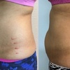 Image 2: Transform Your Body with Non-Invasive Laser Lipo Treatments!