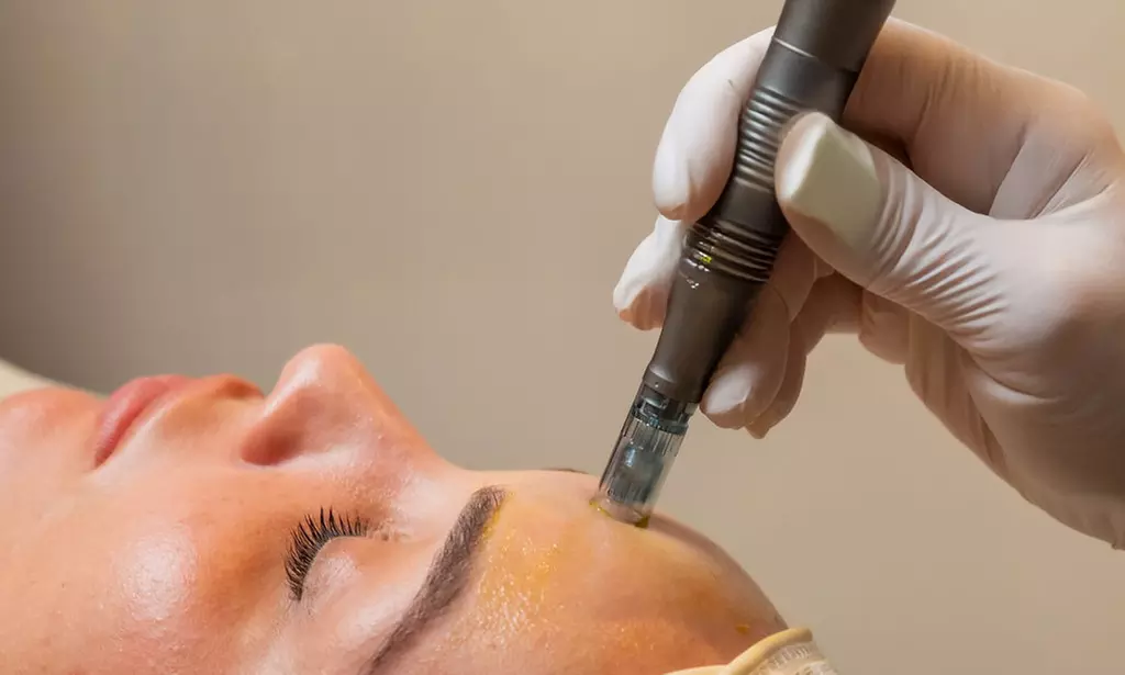 Revive Your Glow With Microneedling Or PRP Upgrade For A Powerful Skin Boost (Up to 46% Off) at Zeugma Spa - Second Medium