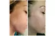 1, 2, or 3 IPL Photo Facials at Laser Options by Jen LLC for Redness, Pigmentation & Fine Lines (Up to 60% Off) - Second Medium