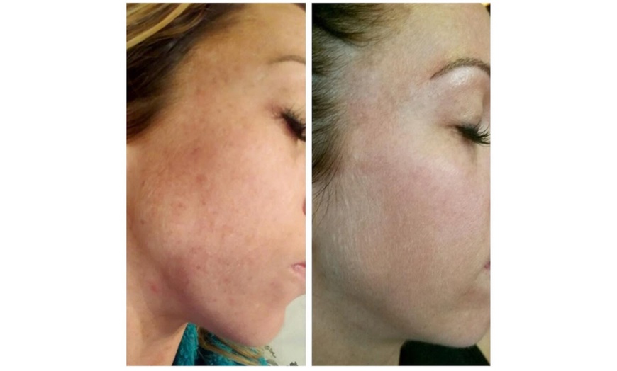 Image 3: 1, 2, or 3 IPL Photo Facials to Target Redness, Pigmentation & Texture
