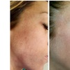 Image 3: 1, 2, or 3 IPL Photo Facials to Target Redness, Pigmentation & Texture