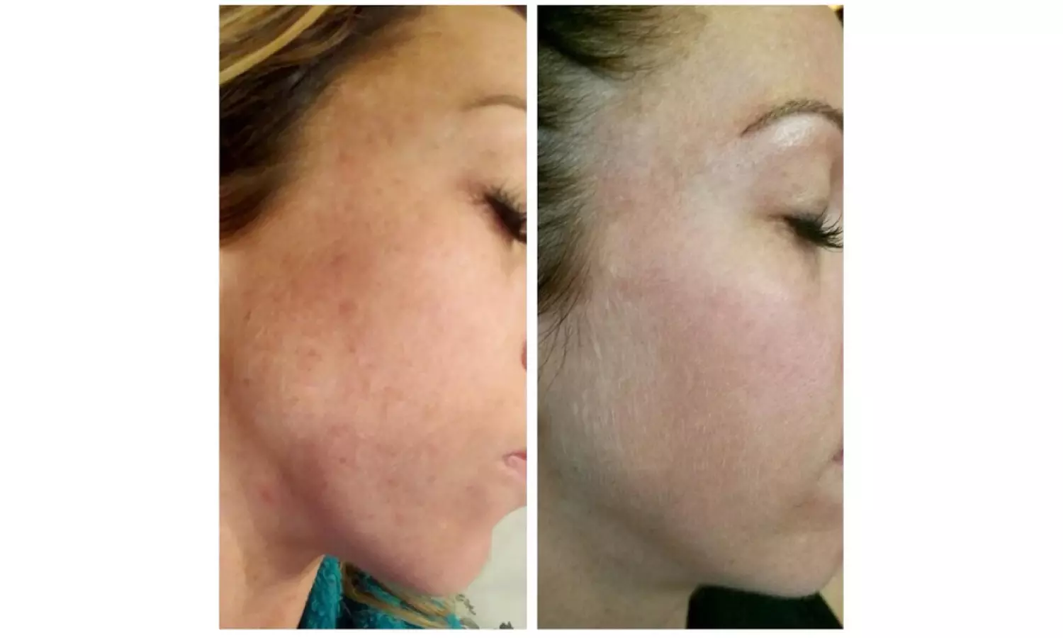 1, 2, or 3 IPL Photo Facials to Target Redness, Pigmentation & Texture