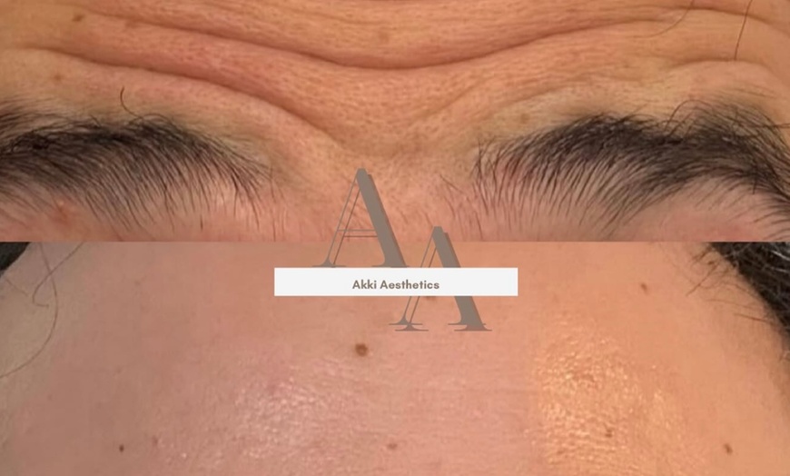 Image 2: 20, 40, or 60 Units of Botox And Filler for Rejuvenating Your Skin 