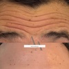 Image 2: 20, 40, or 60 Units of Botox And Filler for Rejuvenating Your Skin 