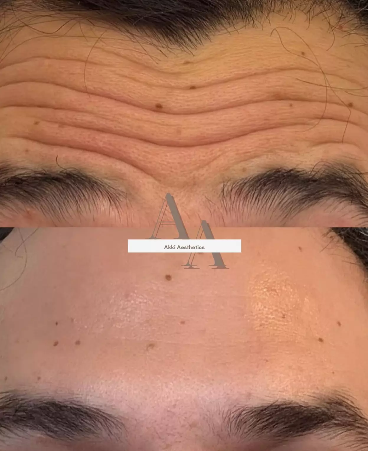 The Ageless Look: Premium Botox® and Filler Bundles At AK Medical Spa