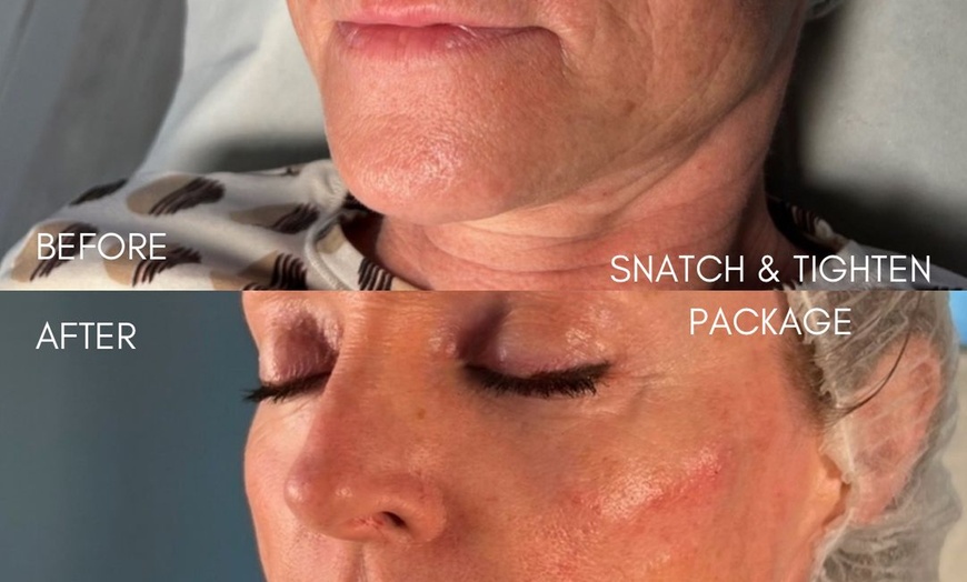 Image 11: Revitalize with 1ml, 2ml, or 3ml Dermal Fillers for Cheek, Jaw or Chin