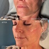 Image 11: Revitalize with 1ml, 2ml, or 3ml Dermal Fillers for Cheek, Jaw or Chin