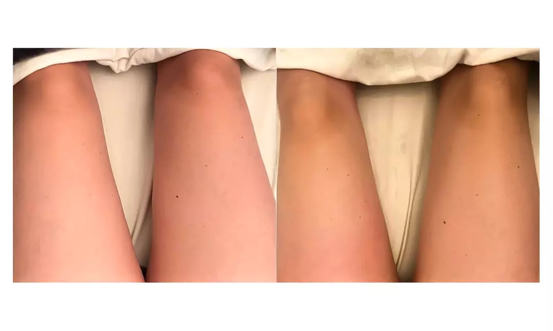 3, 6, 9, or 12 Cavitation, Radiofrequency, and Vacuum Package