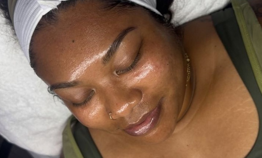 Image 9: Up to 63% Off on Chemical Peel at Allure Passions Aesthetic Clinic