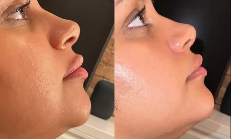 Save Up to $420Off on RHA Dermal Fillers @Abundant Aesthetics Smooth, Lift, & Restore for Naturally Radiant Skin - Second Medium