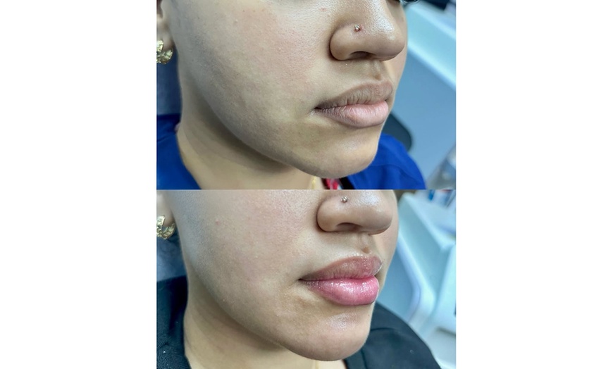 Image 4: Revitalize with One (1.2ml) or Two (2.4mL) Syringes of Revanesse Versa