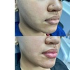 Image 4: Revitalize with One (1.2ml) or Two (2.4mL) Syringes of Revanesse Versa