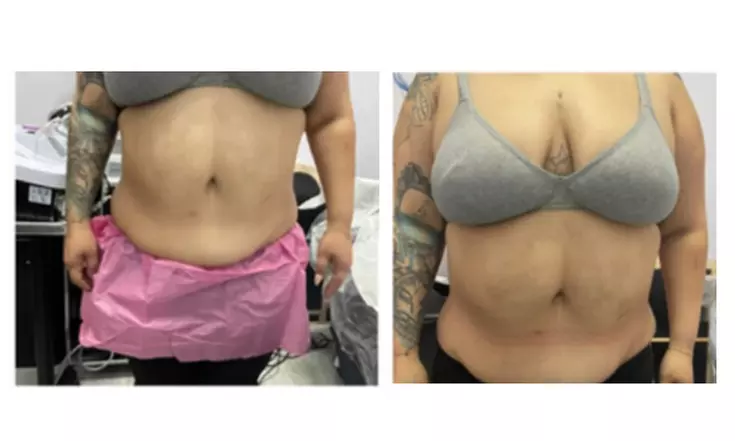 Sculpt Your Body with 2 Ultrasonic-Cavitation Sessions at Kavivahs (Up to 30% Off) - Second Medium