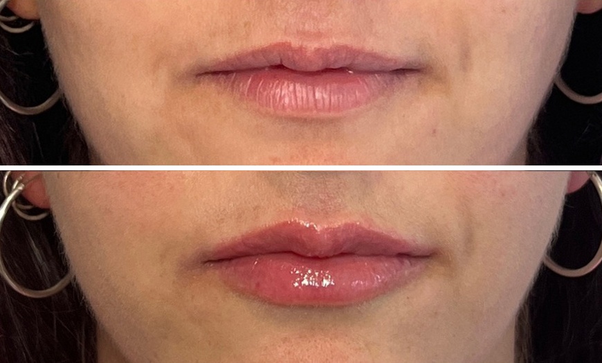 Image 5: 0.5, 1 or 2ml Dermal Filler w/ Consultation: Lip, Smile, Cheek or Chin