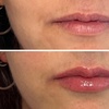 Image 5: 0.5, 1 or 2ml Dermal Filler w/ Consultation: Lip, Smile, Cheek or Chin