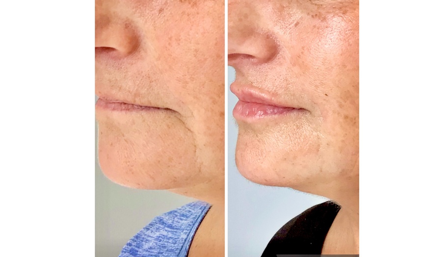 Image 3: Revitalize with 20 or 40 Units of Botox Or One Flip Lip