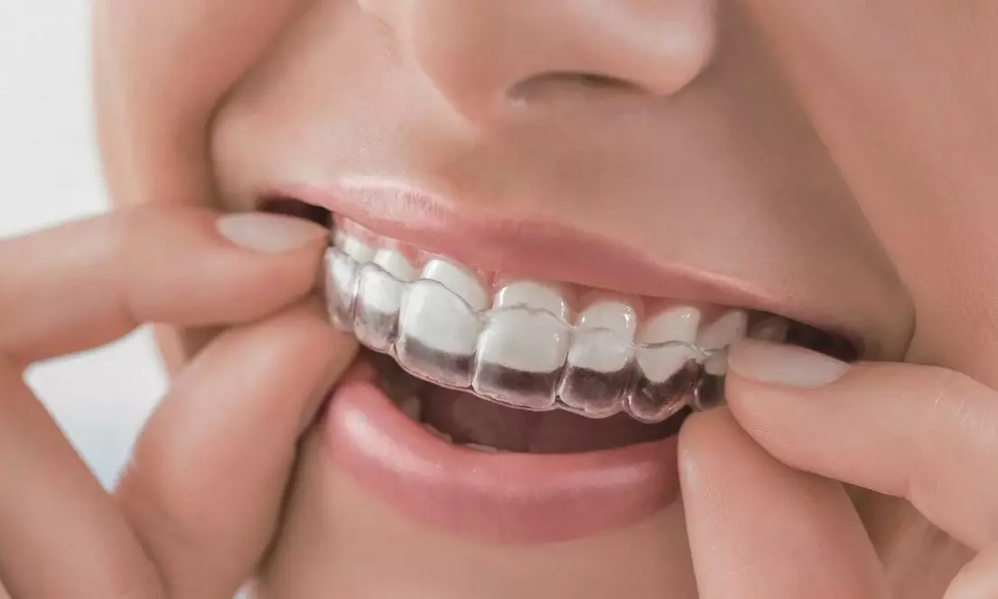 Clear Aligners Or Invisalign Plus Dental Exam, X-Ray and Cleaning For One Person Up to 80% Off