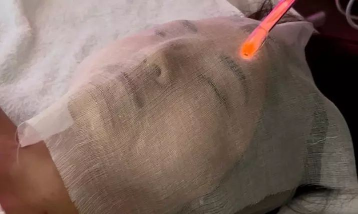 60 Min Microdermabrasion Facial w/ Mask+LED Therapy - 1, 3/ 5 Sessions