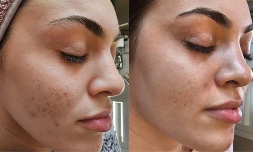 Image 4: 1 or 3 Sessions: Skin Needling + Facial Sheet Mask + LED Light Therapy