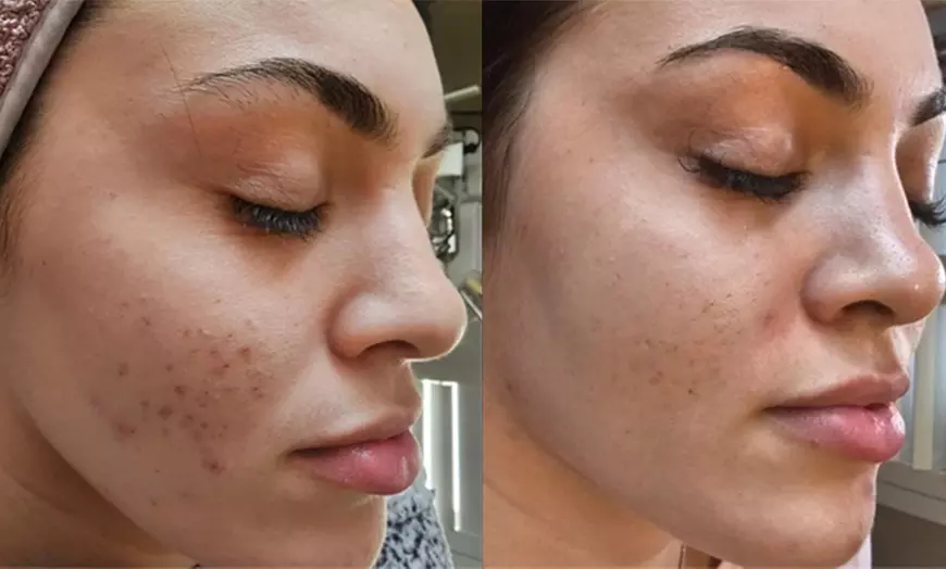 Image 3: 1 or 3 Sessions: Skin Needling + Facial Sheet Mask + LED Light Therapy