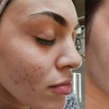 Image 4: 1 or 3 Sessions: Skin Needling + Facial Sheet Mask + LED Light Therapy