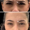 Image 1: Smooth, Lift, and Rejuvenate with 20 Units of Botox 