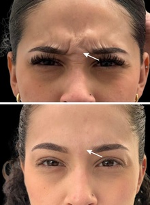 20 Units of Botox - Las Olas Med Spa