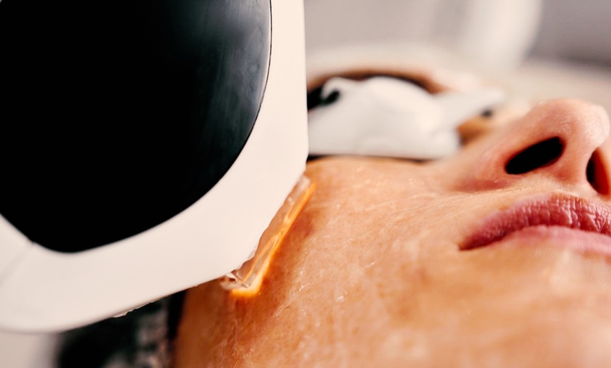 Image 3: Revitalize with One IPL with or Without RF Treatment For Dry Eye 
