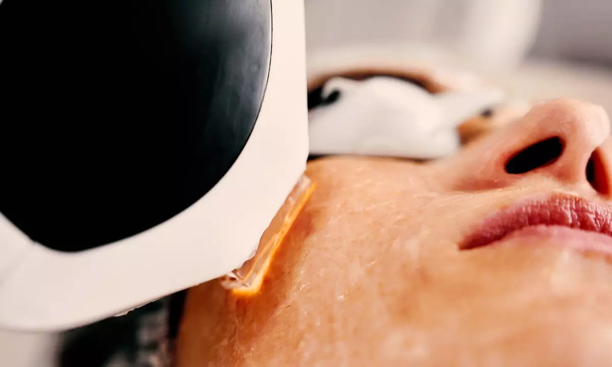 Revitalize with One IPL with or Without RF Treatment For Dry Eye