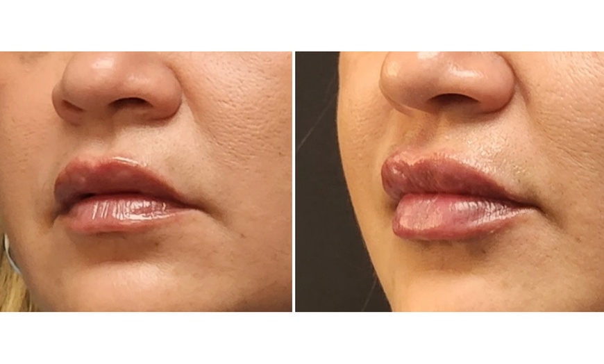 Image 2: Smooth Fine Lines & Refresh Your Look with Botox or Filler Treatments