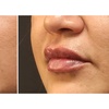Image 2: Smooth Fine Lines & Refresh Your Look with Botox or Filler Treatments