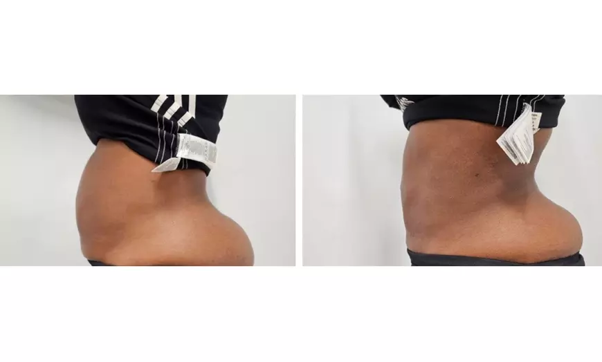 Image 7: Enjoy Pressotherapy Lymphatic Massage, RF Tightening, or Cavitation!