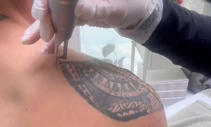 Image 3: Tijd voor een schone lei: verwijder je tattoo met 1 laserbehandeling