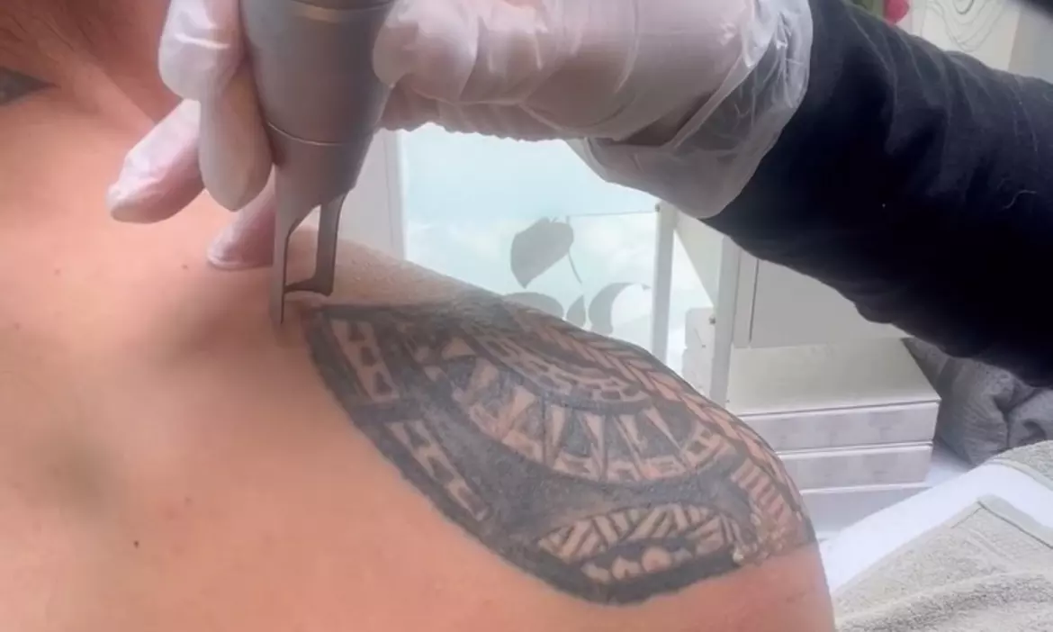 Tijd voor een schone lei: verwijder je tattoo met 1 laserbehandeling