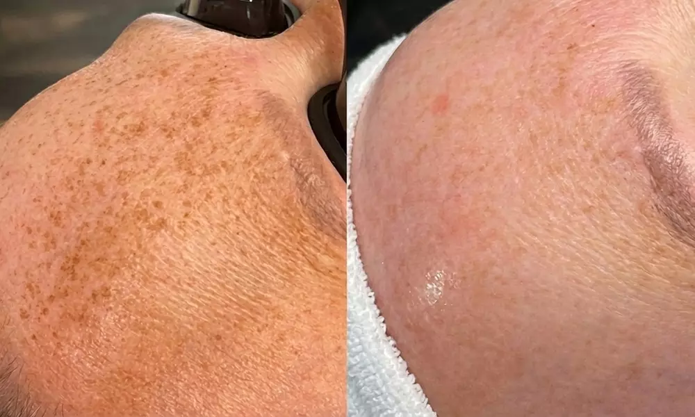 Revive Your Radiance: One IPL Photo Facial for Face, Neck and Optional Chest (Up to 55% Off)