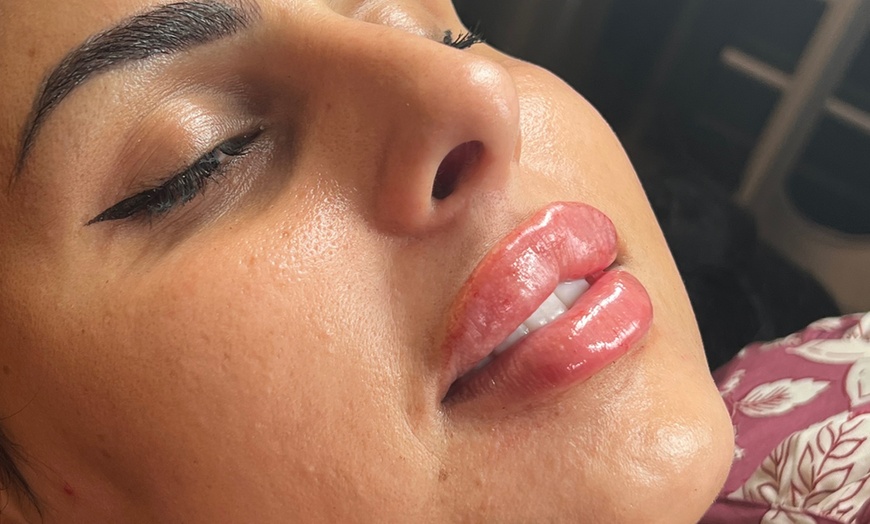 Image 1: 1 or 2 ML For Lip or Chin or Cheek with Consultation