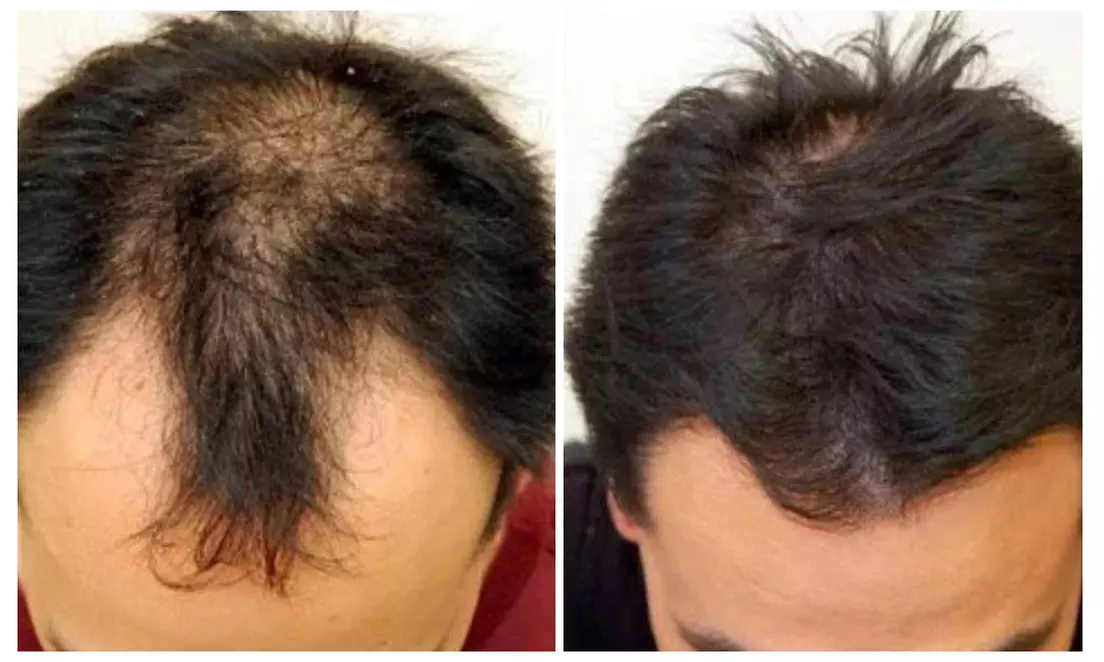 1 or 2ml of Dermal Filler or Aesthetic Treatments – Rejuvenate