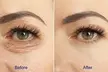 1 or 2 Sessions of Polynucleotides for Eyes or Face at Aesthetics bycoco(Up To 65% Off) - Image 2