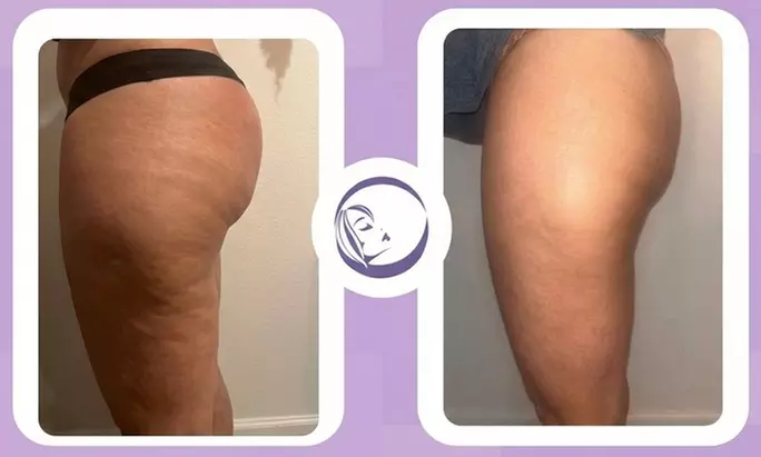 Achieve a Transformed Body: One, Three, Five or Ten Body Contouring and Fat Reduction Treatments (Up to 54% Off) - Second Medium