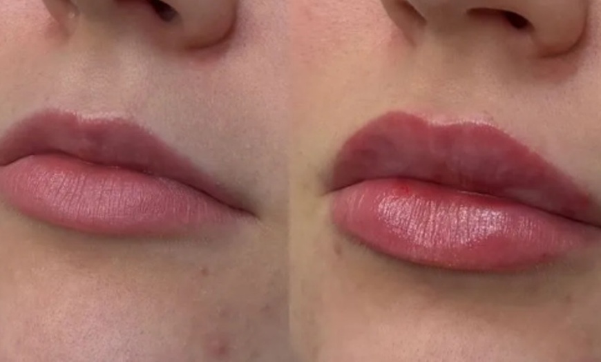 Image 4: Choose from Half Syringe, Full Syringe, or Lip + Tox Combo 