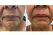 Lip Flip or 20–40 Xeomin Units for Smoother Skin & Fuller Lips at Slim Fit Beauty Up To  59% Off - Second Medium