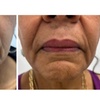 Image 6: Lip Flip or 20–40 Units of Xeomin for a Smooth, Youthful Look 