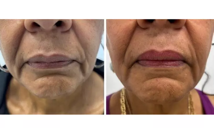 Lip Flip or 20–40 Units of Xeomin for a Smooth, Youthful Look