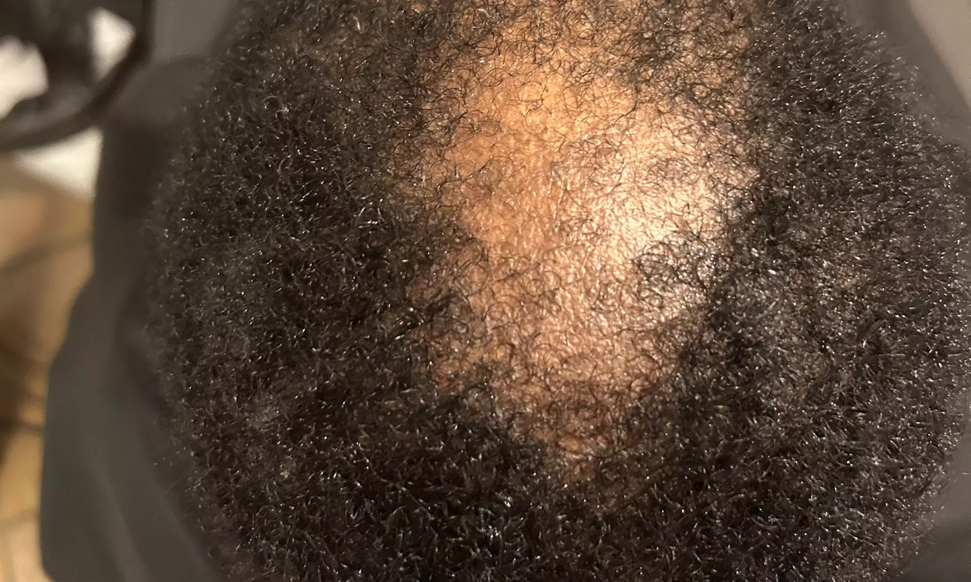 Get a Trichology Hair Loss Consultation at Beautyonscales_byTanika Up to 30% Off  - Second Medium