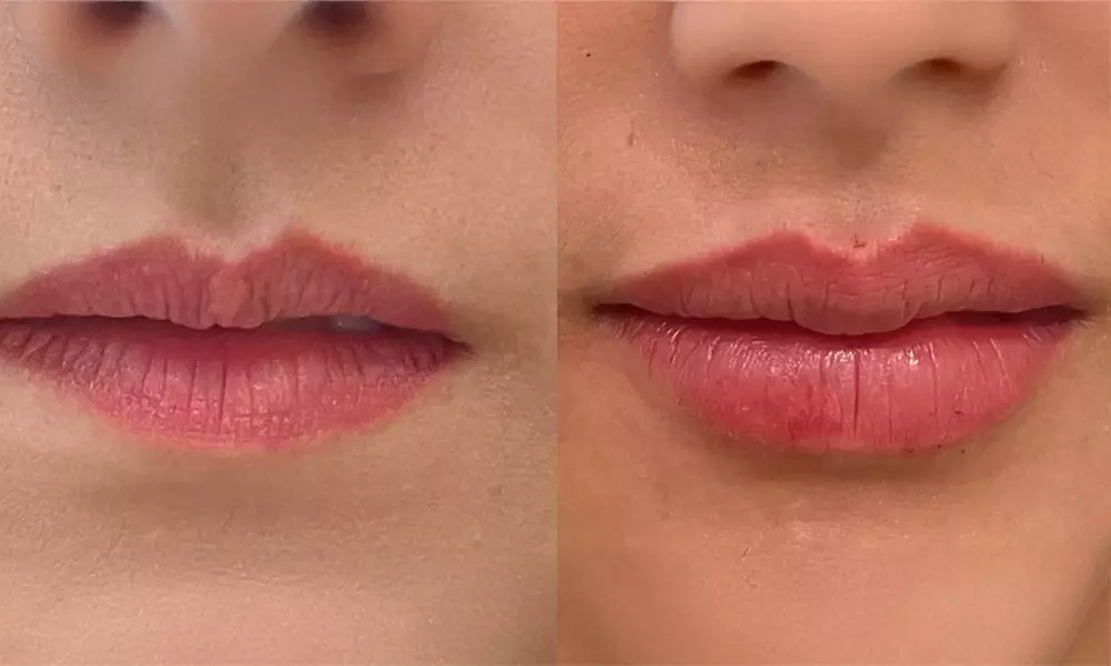 One Syringe of Juvederm Volbella or Ultra XC
