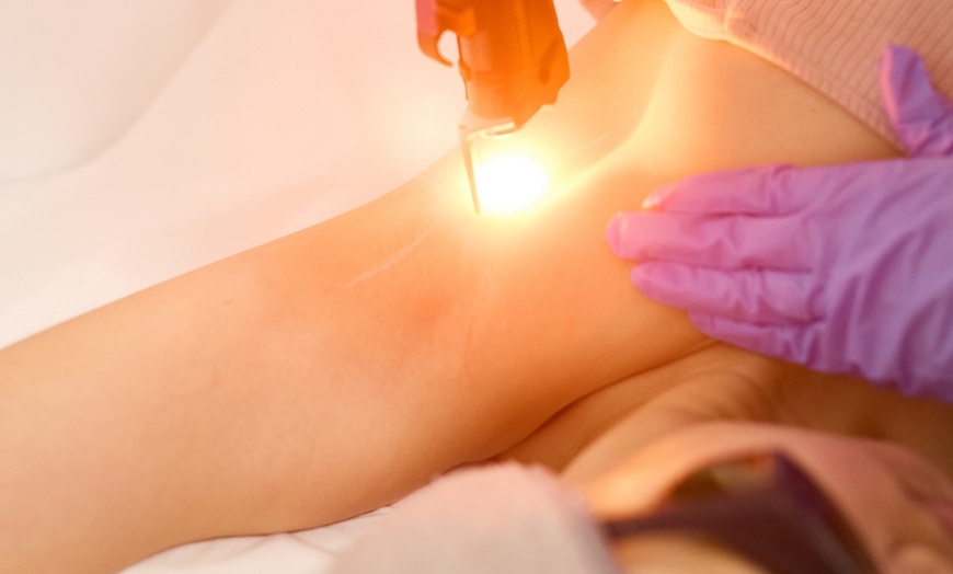 Image 6: Get Smooth Skin w/ 4 or 6 LHR Session for Small, Medium, or Large Area