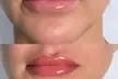 Achieve Perfect Lips with One Lip Blush Session with Optional Touch-Up @The Blush House(Up to 50% Off) - Second Medium