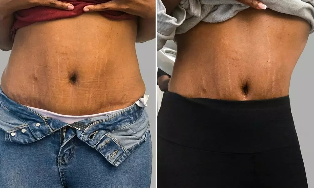 Sculpt Away Fat with Laser-Lipo Treatments